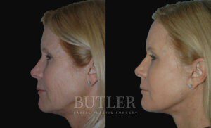 Facelift Before and After Patient Thumbnail 2