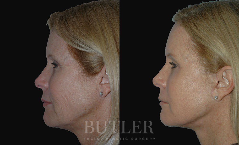 Facelift Before and After Patient 2