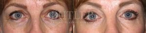Blepharoplasty Before and After Patient Thumbnail 1