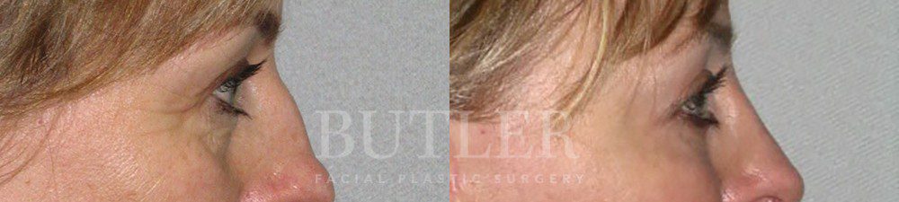 Blepharoplasty Before and After Patient 2