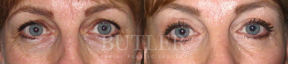 Blepharoplasty Before and After Patient 1