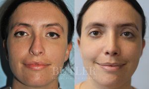 Revision Rhinoplasty Before and After Patient Thumbnail 1