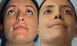 Revision Rhinoplasty Before and After Patient Thumbnail 2