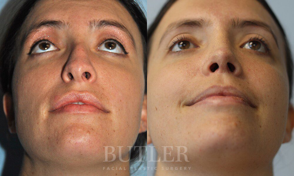 Revision Rhinoplasty Before and After Patient 2