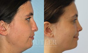 Revision Rhinoplasty Before and After Patient Thumbnail 3