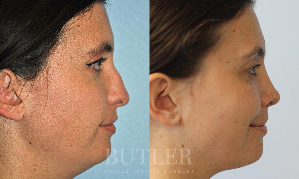 Revision Rhinoplasty Before and After Patient 3