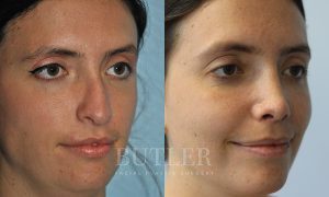 Revision Rhinoplasty Before and After Patient Thumbnail 4