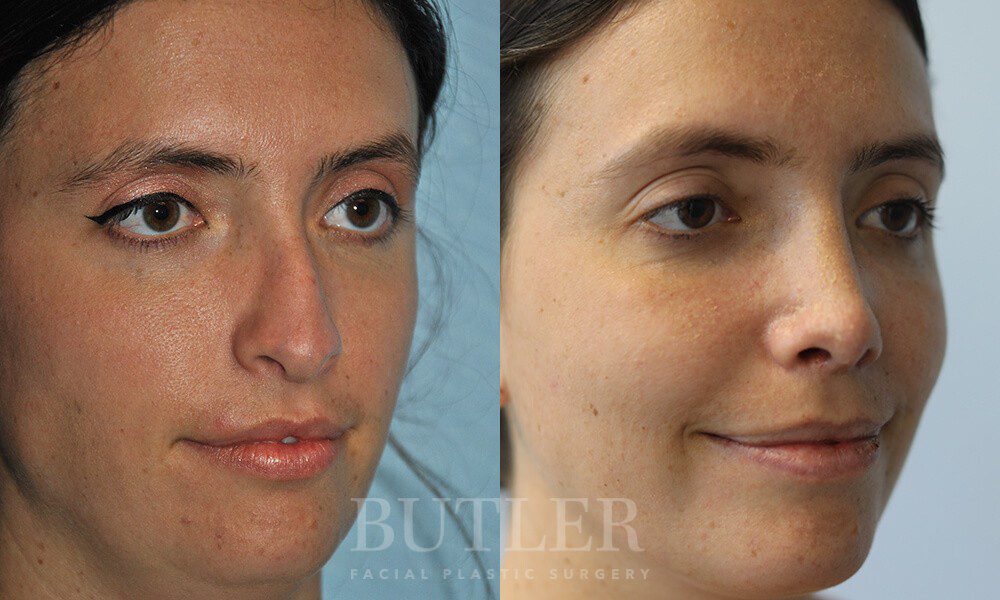 Revision Rhinoplasty Before and After Patient 4
