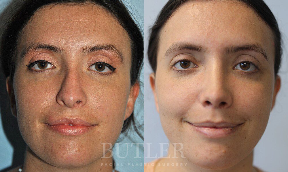 Revision Rhinoplasty Before and After Patient 1