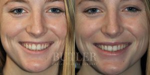 Lip Augmentation Before and After Patient Thumbnail 2