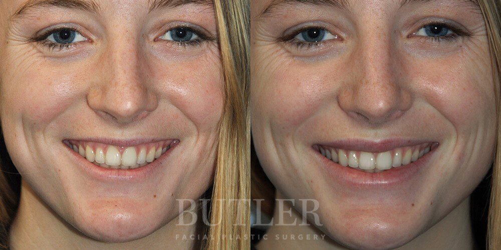 Lip Augmentation Before and After Patient 2