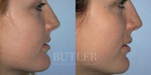 Lip Augmentation Before and After Patient Thumbnail 3
