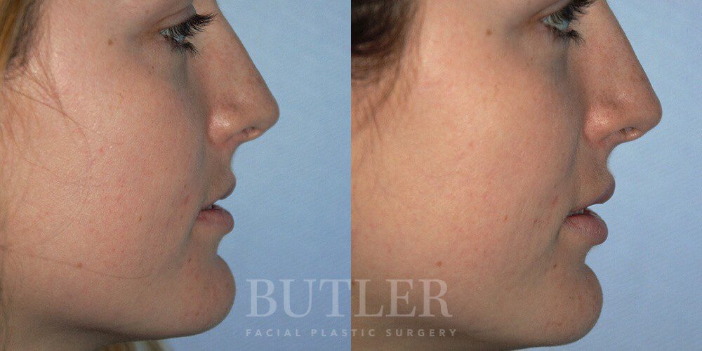 Lip Augmentation Before and After Patient 3