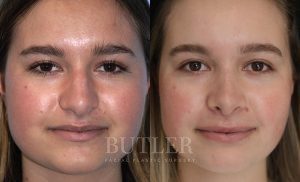 Rhinoplasty Before and After Patient Thumbnail 1