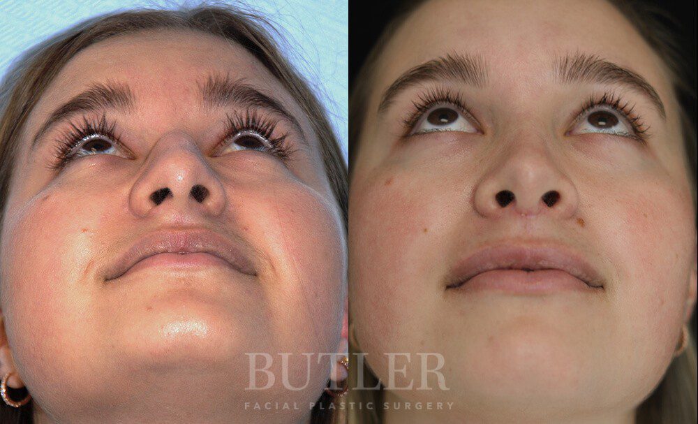 Rhinoplasty Before and After Patient 2