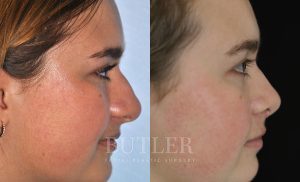 Rhinoplasty Before and After Patient Thumbnail 4