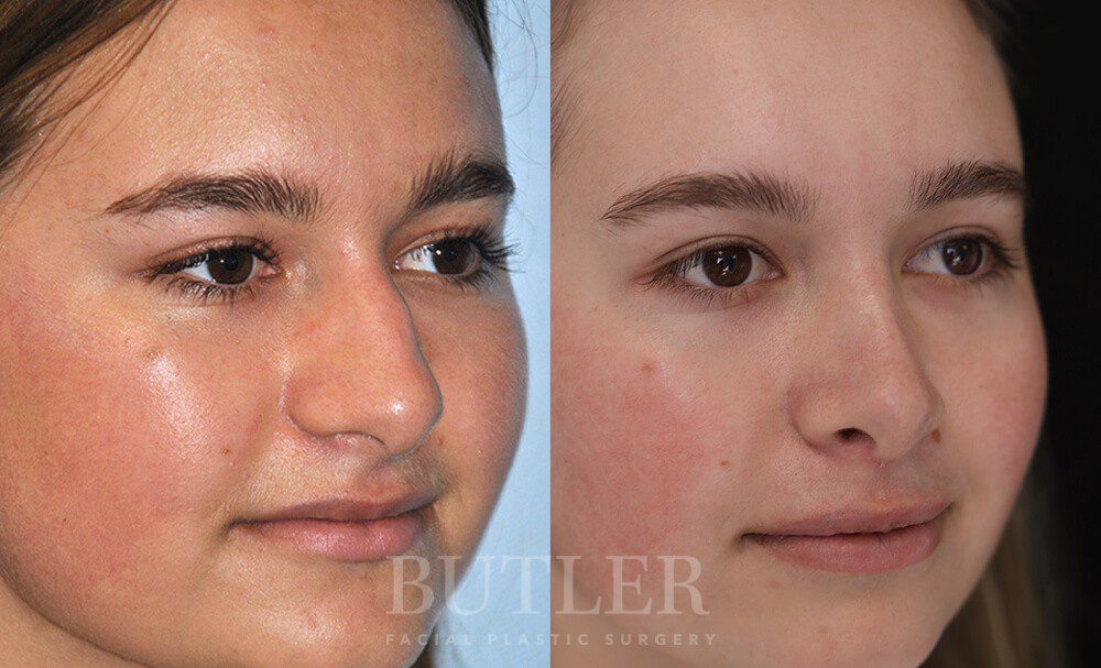 Rhinoplasty Before and After Patient 3