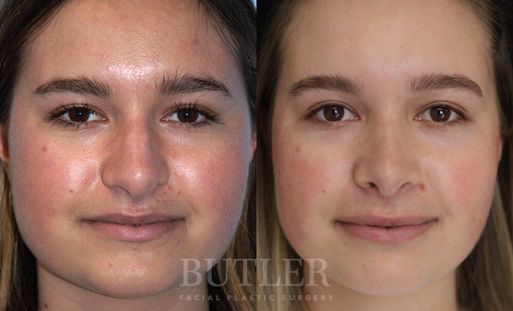 Rhinoplasty Before and After Patient 1