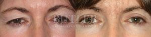 Brow Lift Before and After Patient Thumbnail 1