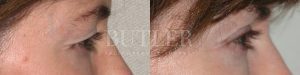 Brow Lift Before and After Patient Thumbnail 2