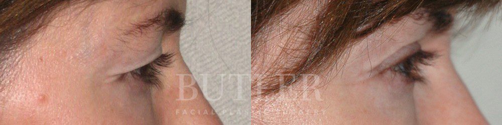 Brow Lift Before and After Patient 2