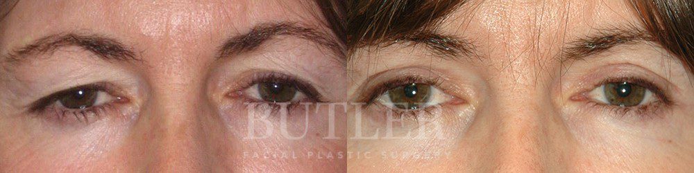 Brow Lift Before and After Patient 1
