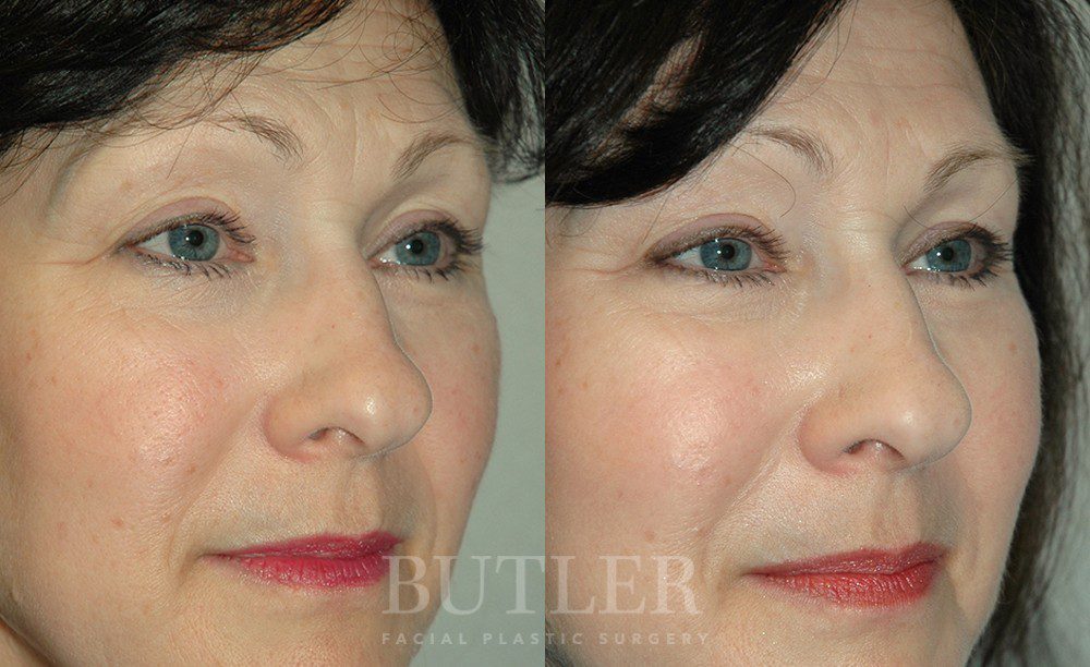 Mid-Facelift Before and After Patient 1