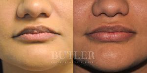 Lip Augmentation Before and After Patient Thumbnail 1