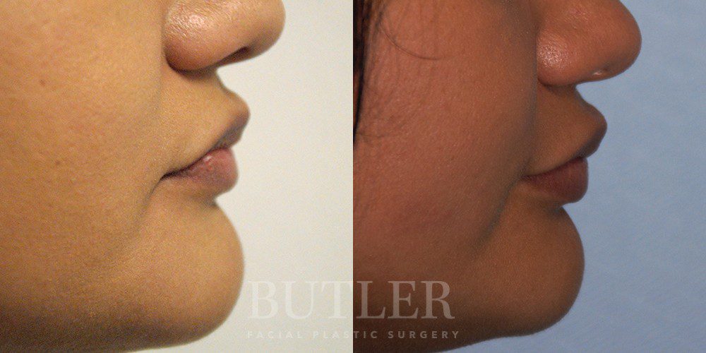 Lip Augmentation Before and After Patient 2