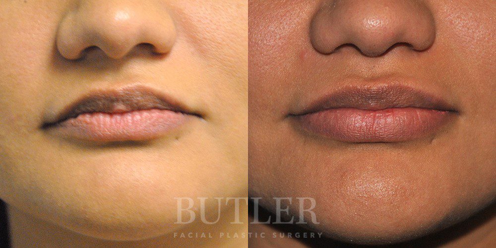 Lip Augmentation Before and After Patient 1