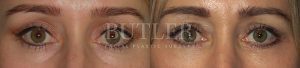 Blepharoplasty Before and After Patient Thumbnail 1