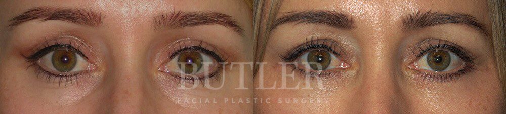 Blepharoplasty Before and After Patient 1