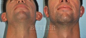 Otoplasty Before and After Patient Thumbnail 1