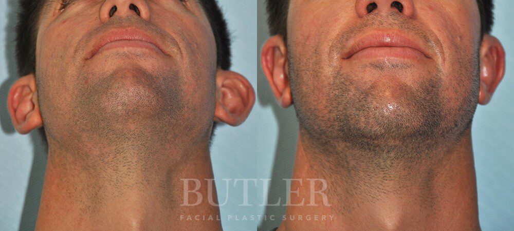 Otoplasty Before and After Patient 1