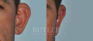 Otoplasty Before and After Patient Thumbnail 3