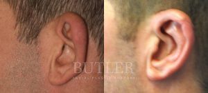 Otoplasty Before and After Patient Thumbnail 2