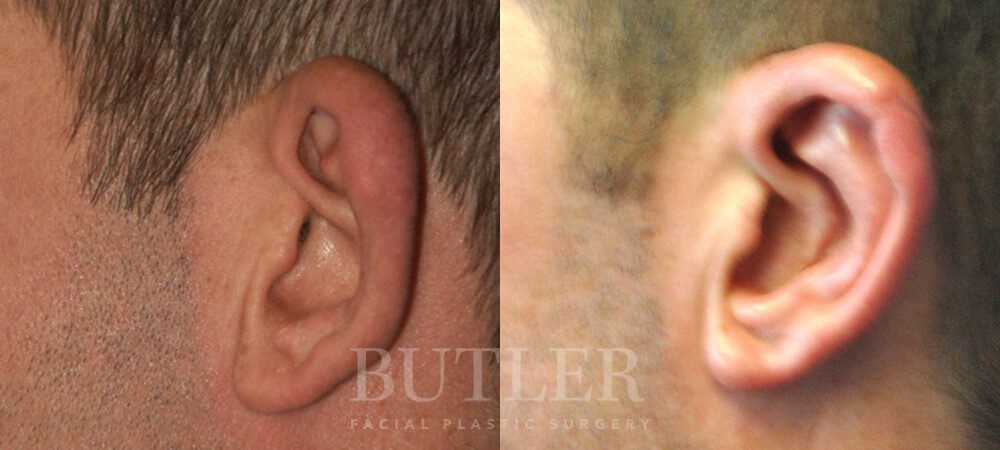 Otoplasty Before and After Patient 2