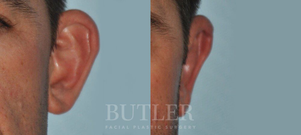 Otoplasty Before and After Patient 3