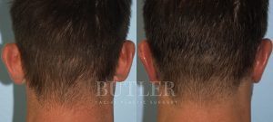 Otoplasty Before and After Patient Thumbnail 6