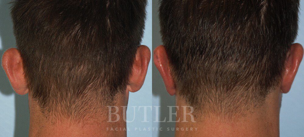 Otoplasty Before and After Patient 6