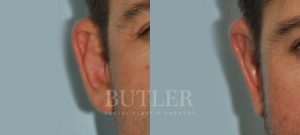 Otoplasty Before and After Patient Thumbnail 5