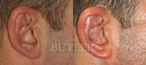 Otoplasty Before and After Patient Thumbnail 4