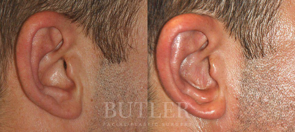 Otoplasty Before and After Patient 4