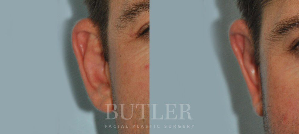 Otoplasty Before and After Patient 5
