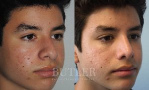 Rhinoplasty Before and After Patient Thumbnail 3