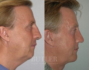 Facelift Before and After Patient Thumbnail 3