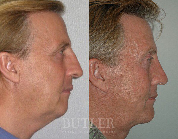 Facelift Before and After Patient 3