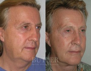 Facelift Before and After Patient Thumbnail 2