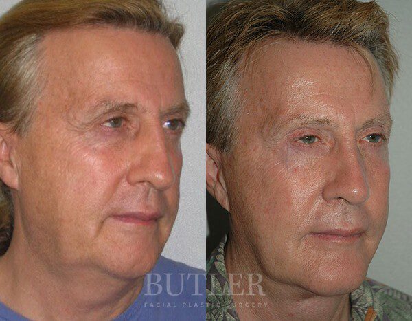 Facelift Before and After Patient 2