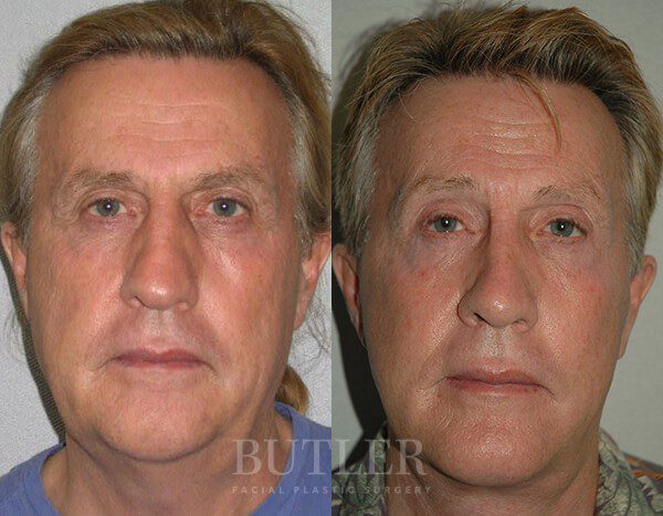 Facelift Before and After Patient 1
